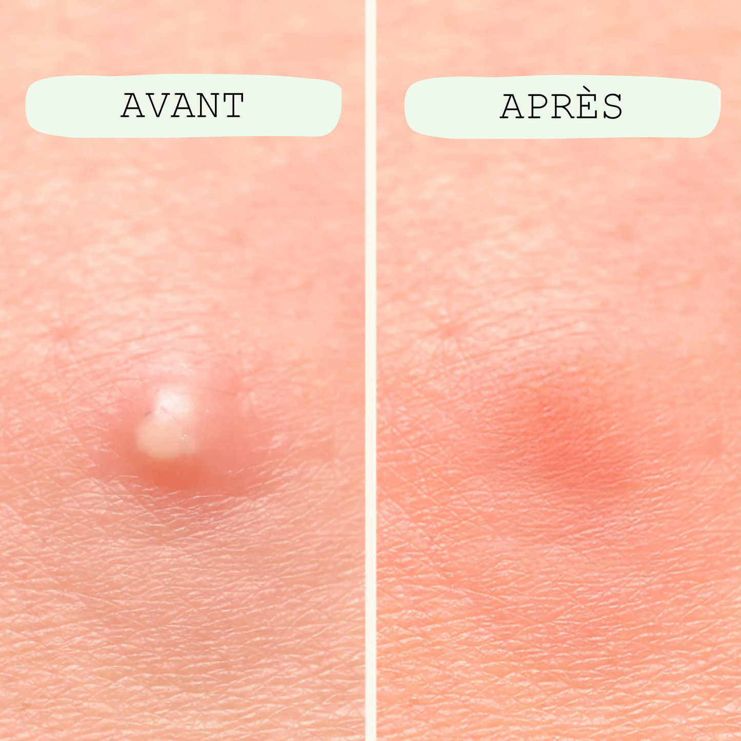 Patch Anti-imperfections / Tailles multiples